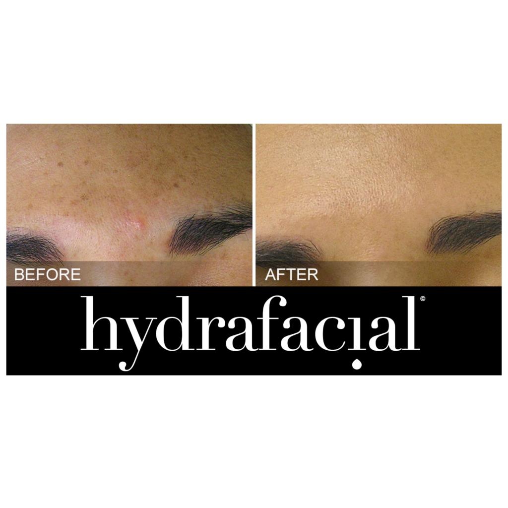 hydrafacial before and after