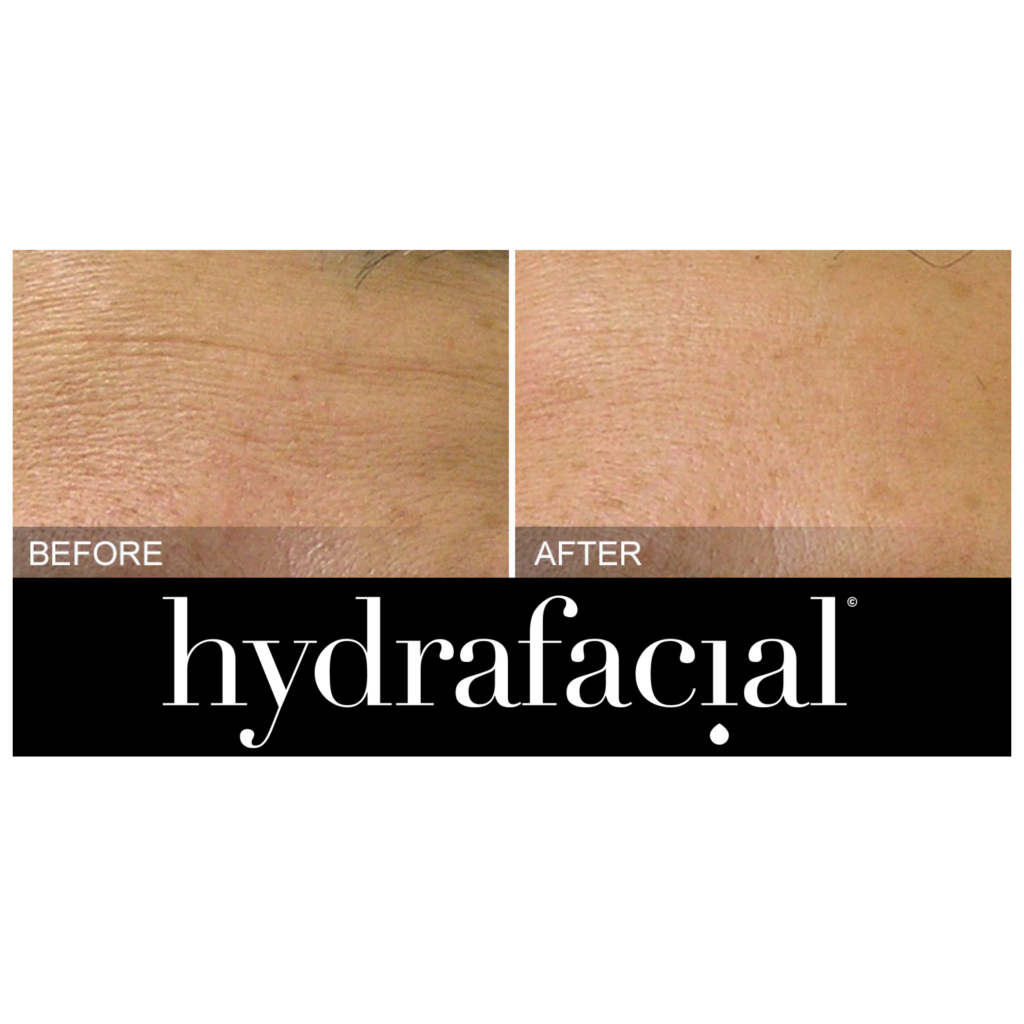 hydrafacial before and after