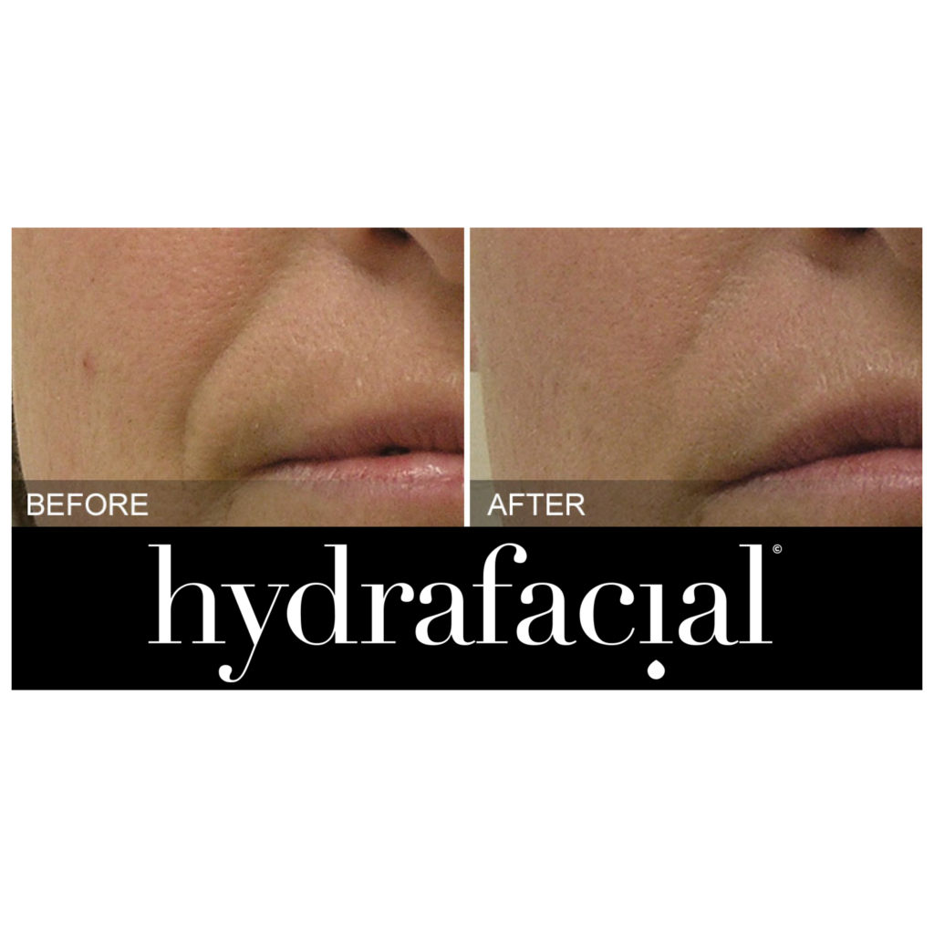 hydrafacial before and after