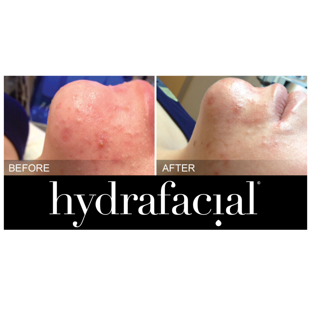 hydrafacial before and after